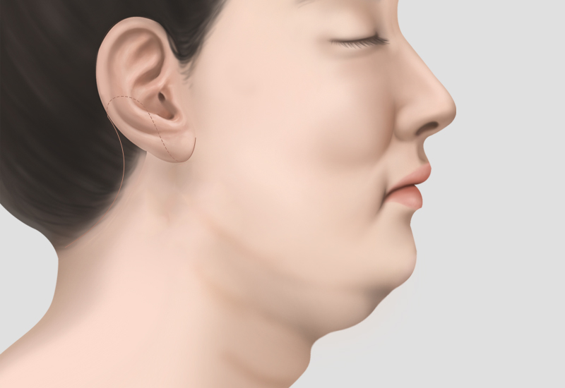 안면거상, 목거상