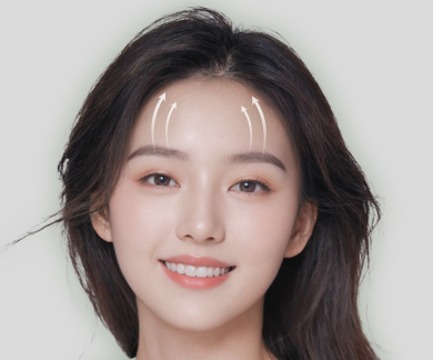 Endotine Forehead Lift
